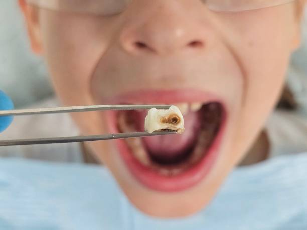 Best Emergency Dental Care for Broken or Chipped Teeth in Osseo, WI